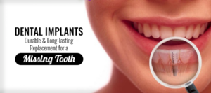 Dental Implants - Durable and Long-lasting Replacement for a Missing Tooth