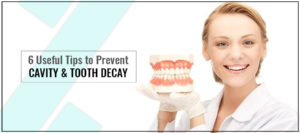 6 Useful Tips to Prevent Cavity and Tooth Decay