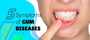 Invisalign treatment in pimpri Chinchwad