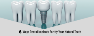 6 Ways Dental Implants Fortify Your Natural Teeth