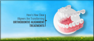 Invisible braces