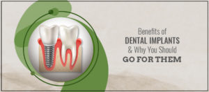 Dental implants in Pimpri Chinchwad