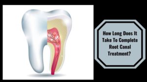 Root canal treatment in Pimpri Chinchwad