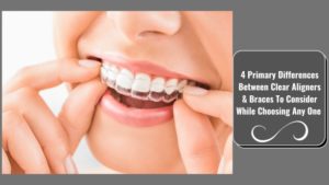 Clear Aligners in Pimpri Chinchwad