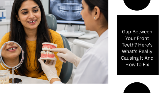 Gap Between Your Front Teeth? Here’s What’s Really Causing It And How to Fix